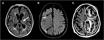 Association of the CHA2D(S2)-VASc Score and Its Components With Overt and Silent Ischemic Brain Lesions in Patients With Atrial Fibrillation